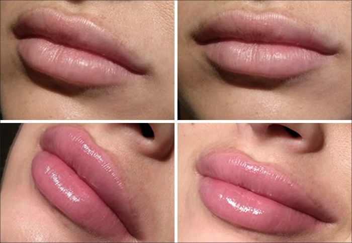 Fillers Halmstad | Infinity Clinic