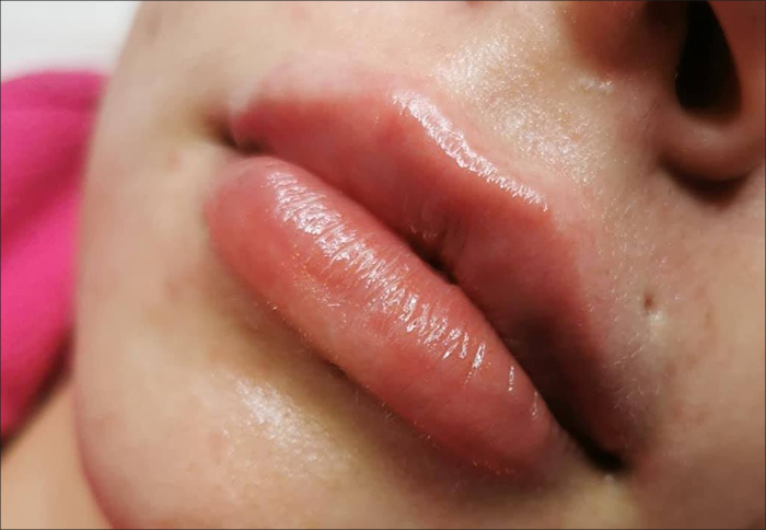 Fillers Luleå | Beauty By Diva