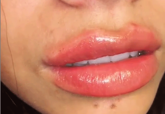 Fillers Växjö | Clinica Maya