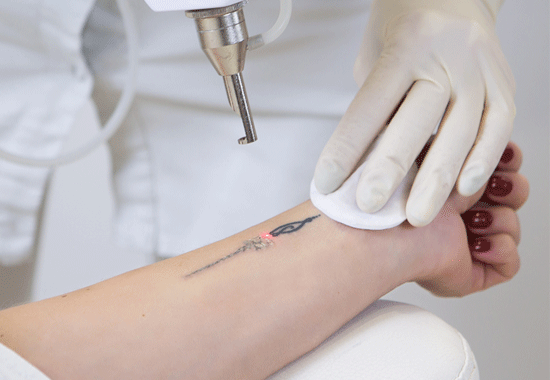 Tatueringsborttagning Helsingborg | Glamtastic